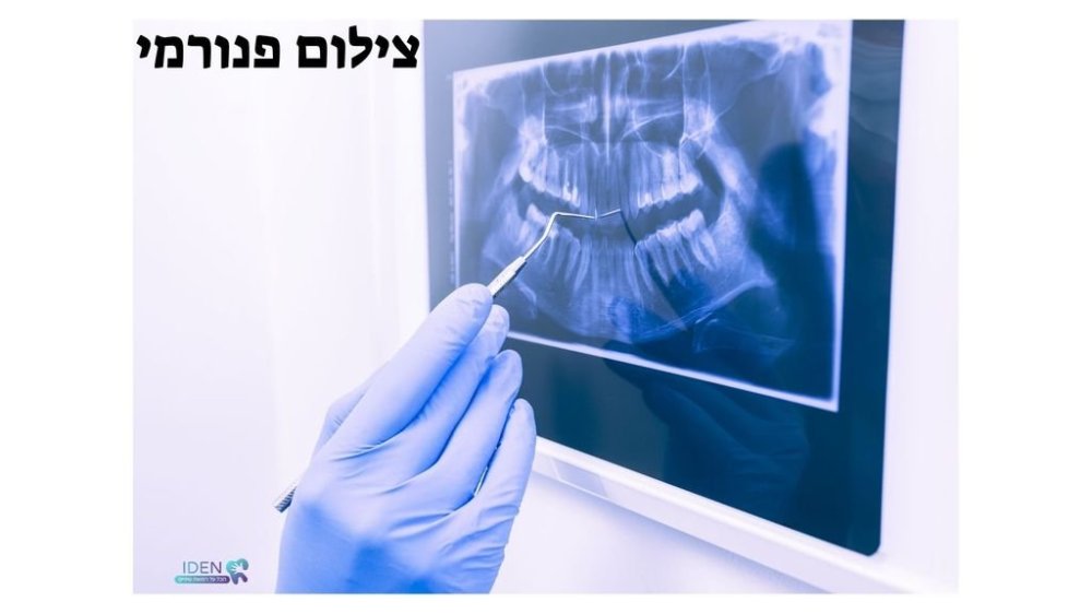 צילום פנורמי של השיניים - מדריך מקיף לבדיקה חיונית