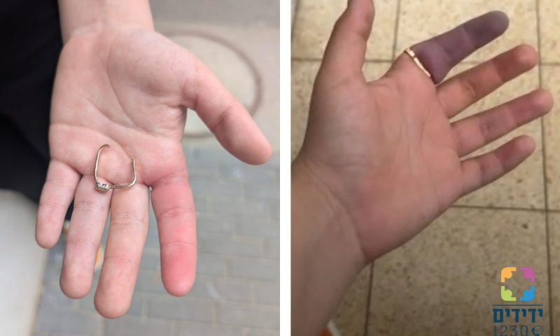 טבעת נתקעה על אצבע אישה בחולון